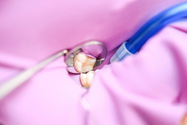 Behandlung mit Kofferdam